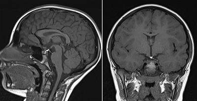 Case Report: Lipoma of the Tuber Cinereum Mimicking a Pituitary Gland Abnormality in a Girl With Central Precocious Puberty